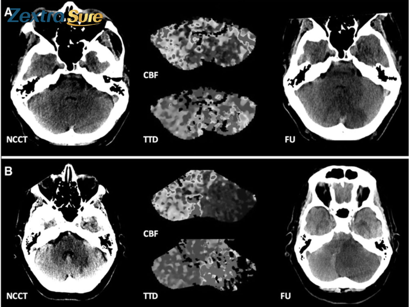 cerebellar-stroke (4)